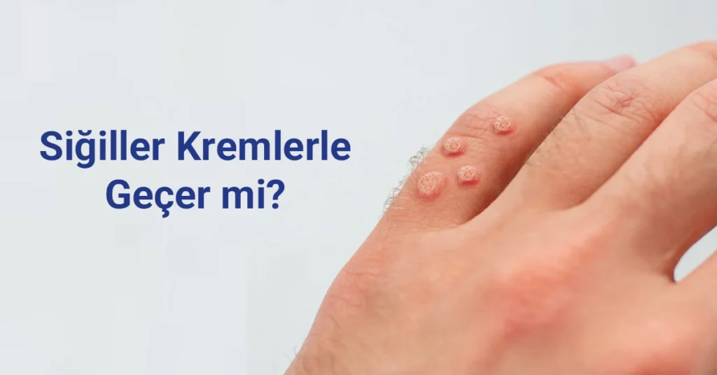 Siğiller tedavi edilmesi gereken HPV kaynaklı lezyonlardır.