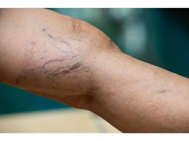 Varis tedavi işlemleri