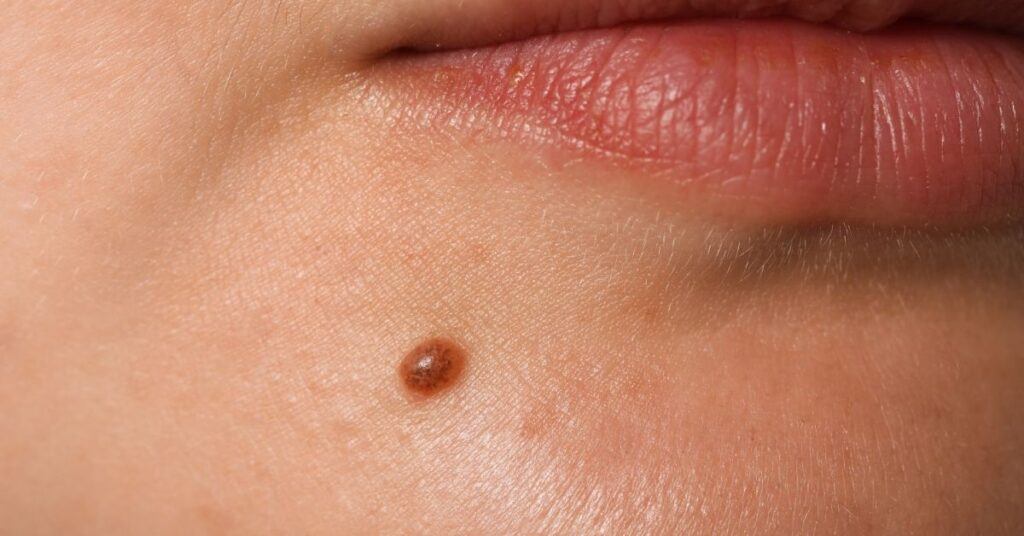 Ben aldırm işlemi sonrası kutalin krem kullanımı yara iyileşme sürecini azaltacaktır.